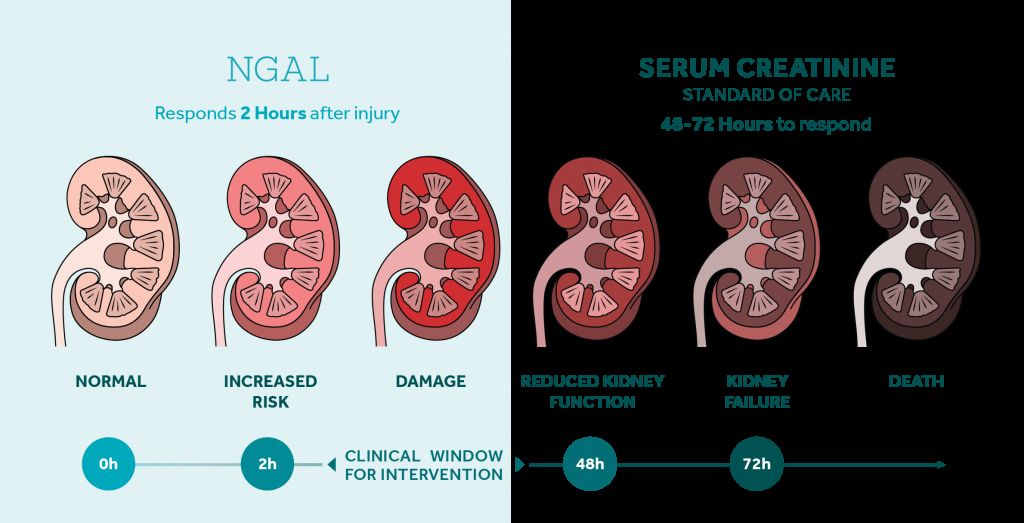 Product Recommendations  NGAL- Early Marker of Acute Kidney  Injury